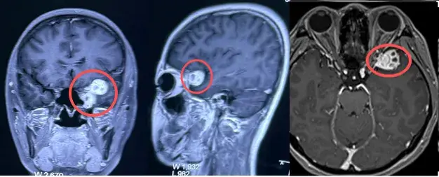 垂体瘤术后全身乏力咋办,垂体瘤几个月都能干活了?